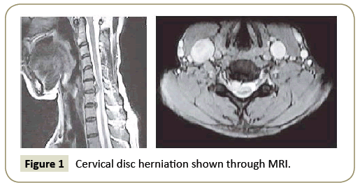 Spine-Research-Cervical-disc