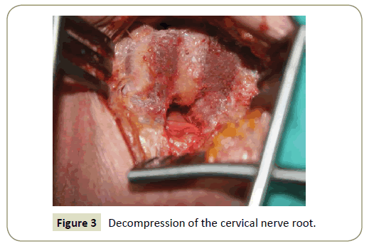 Spine-Research-Decompression