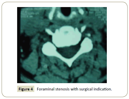 Spine-Research-Foraminal-stenosis