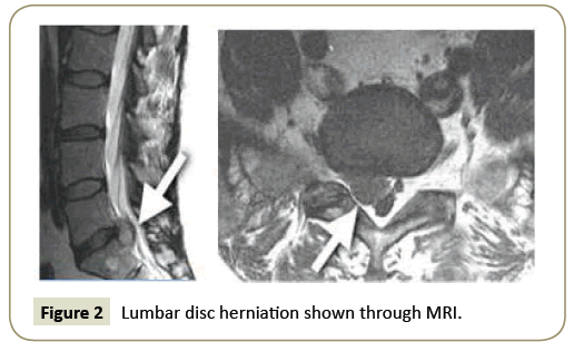 Spine-Research-Lumbar-disc