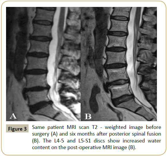 Spine-Research-patient-MRI-scan-weighted