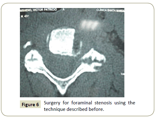 Spine-Research-technique-preserving