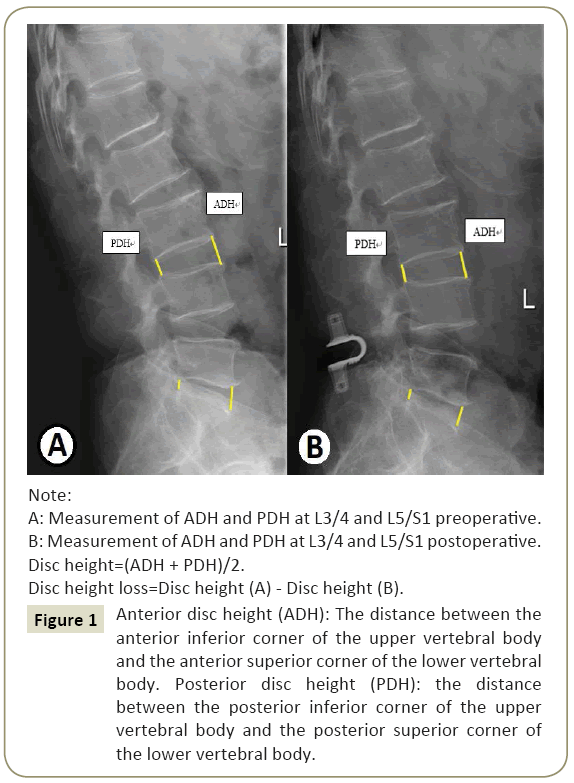 spine-Anterior-disc