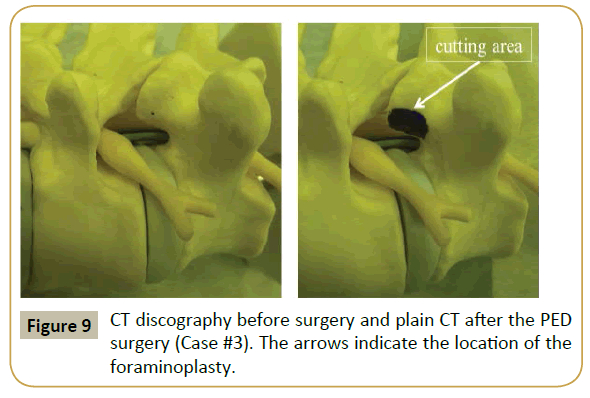 spine-CT-discography