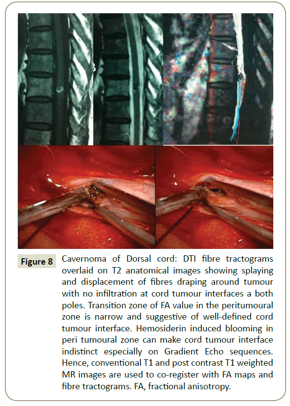 spine-Dorsal-cord