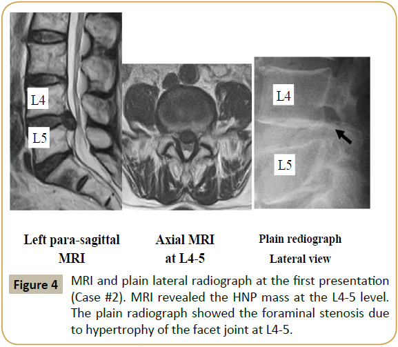 spine-HNP-mass