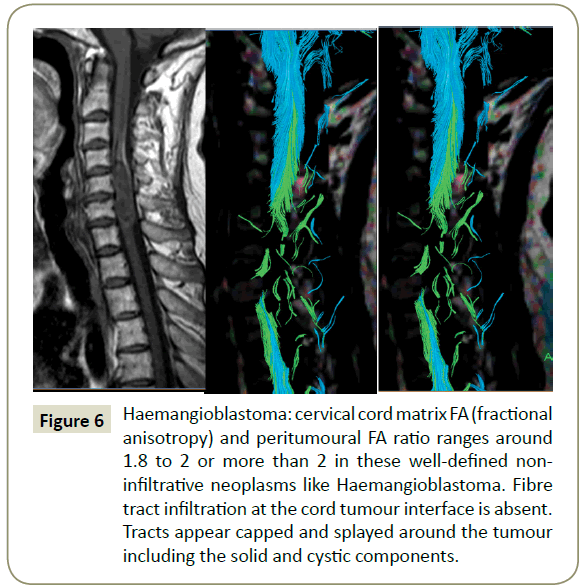 spine-Haemangioblastoma