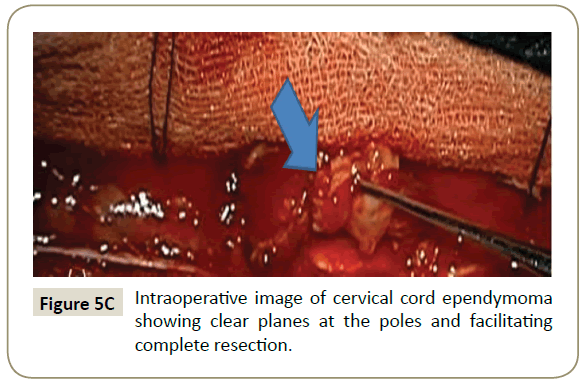 spine-Intraoperative-image