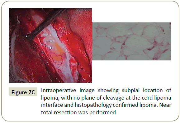 spine-Intraoperative-image