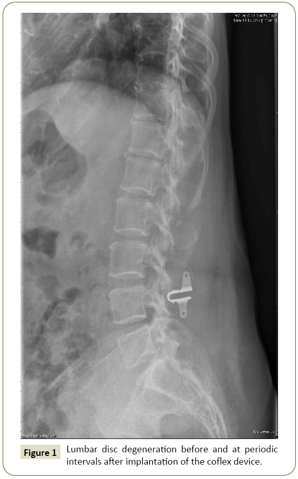 spine-Lumbar-disc
