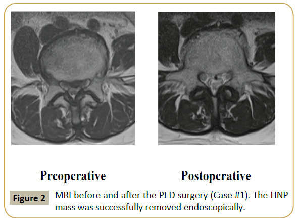 spine-MRI-PED-surgery