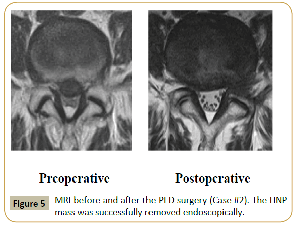 spine-PED-surgery