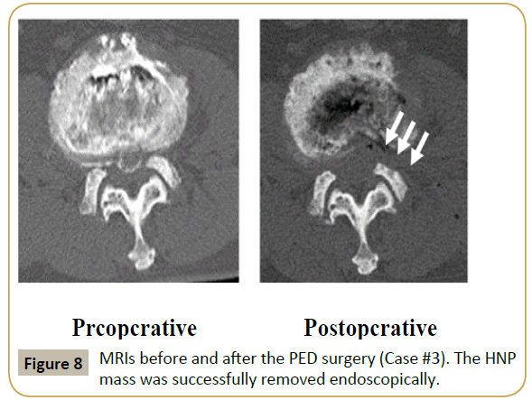 spine-PED-surgery