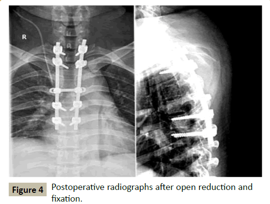 spine-Postoperative-radiographs