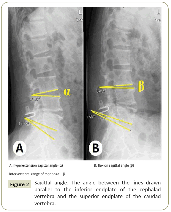 spine-Sagittal-angle