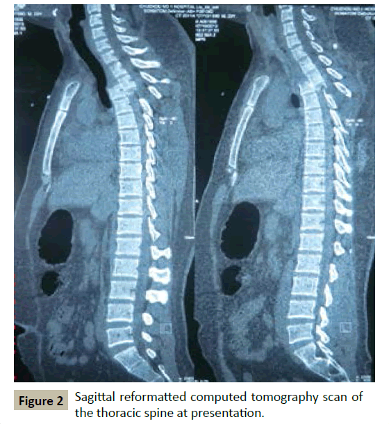 spine-Sagittal-reformatted