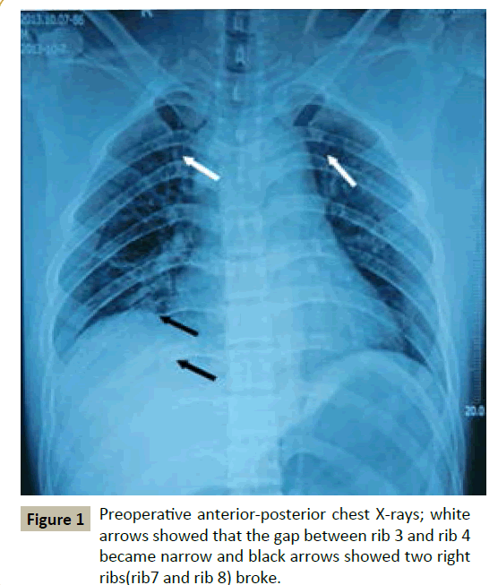 Unusual 2 Stages Posterior Approach Surgical Treatment For Complete Fracture Dislocation Of The Upper Thoracic Spine Without Neurologic Deficit A Case Report Insight Medical Publishing