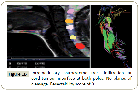 spine-astrocytoma-tract