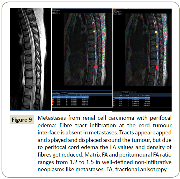 spine-cell-carcinoma