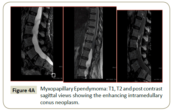 spine-conus-neoplasm