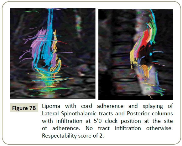 spine-cord-adherence