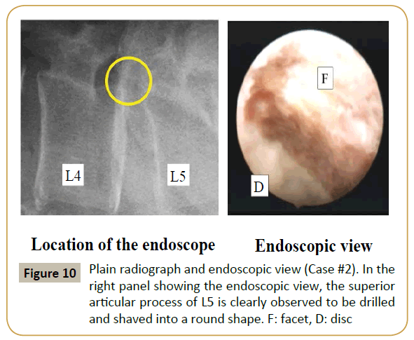 spine-endoscopic-view