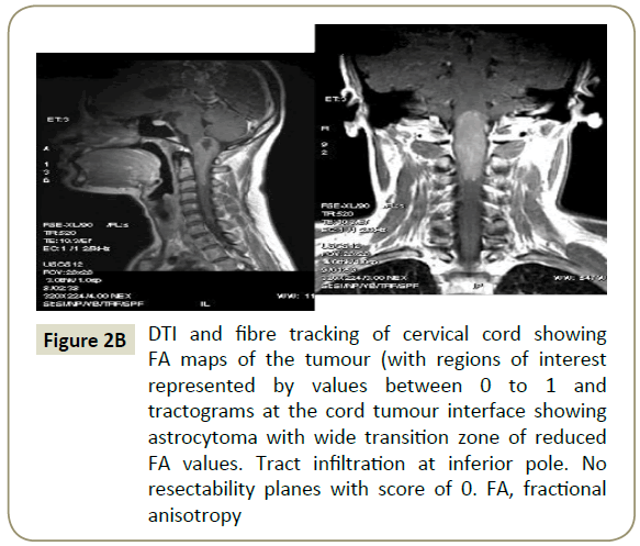 spine-fibre-tracking