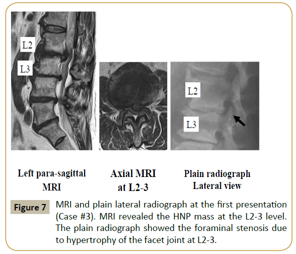 spine-foraminal-stenosis