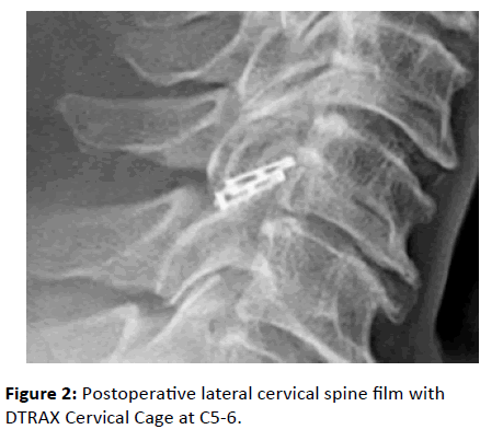 spine-lateral-cervical-spine