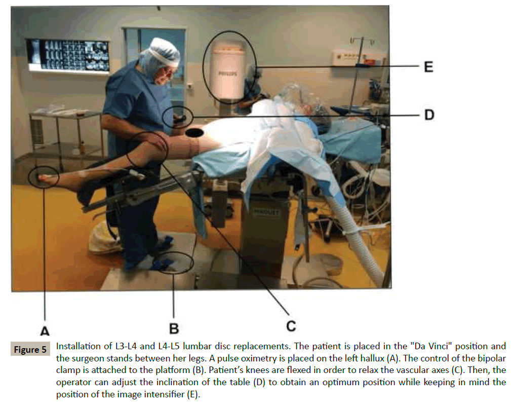 spine-lumbar-disc-replacements