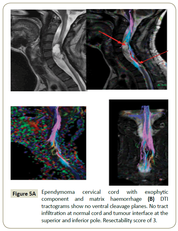 spine-matrix-haemorrhage