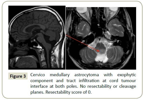 spine-medullary-astrocytoma