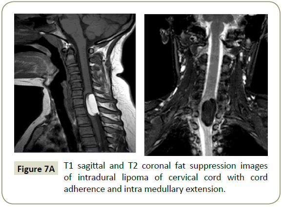 spine-medullary-extension