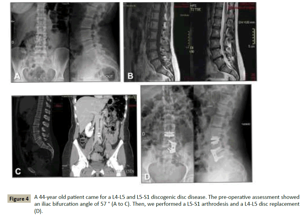 MultiLevel Lumbar Disc Replacements Review of the