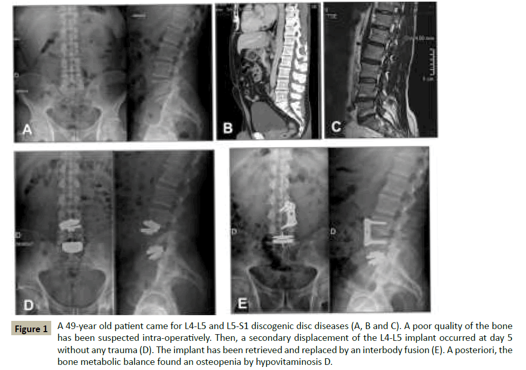 spine-secondary-displacement